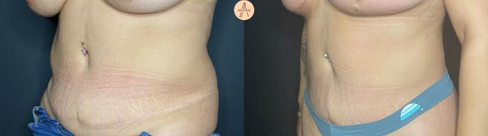 Before & After Liposuction Case 46 Left Oblique View in San Antonio, Texas