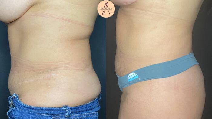 Before & After Liposuction Case 46 Left Side View in San Antonio, Texas