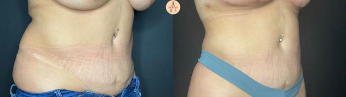Before & After Liposuction Case 46 Right Oblique View in San Antonio, Texas