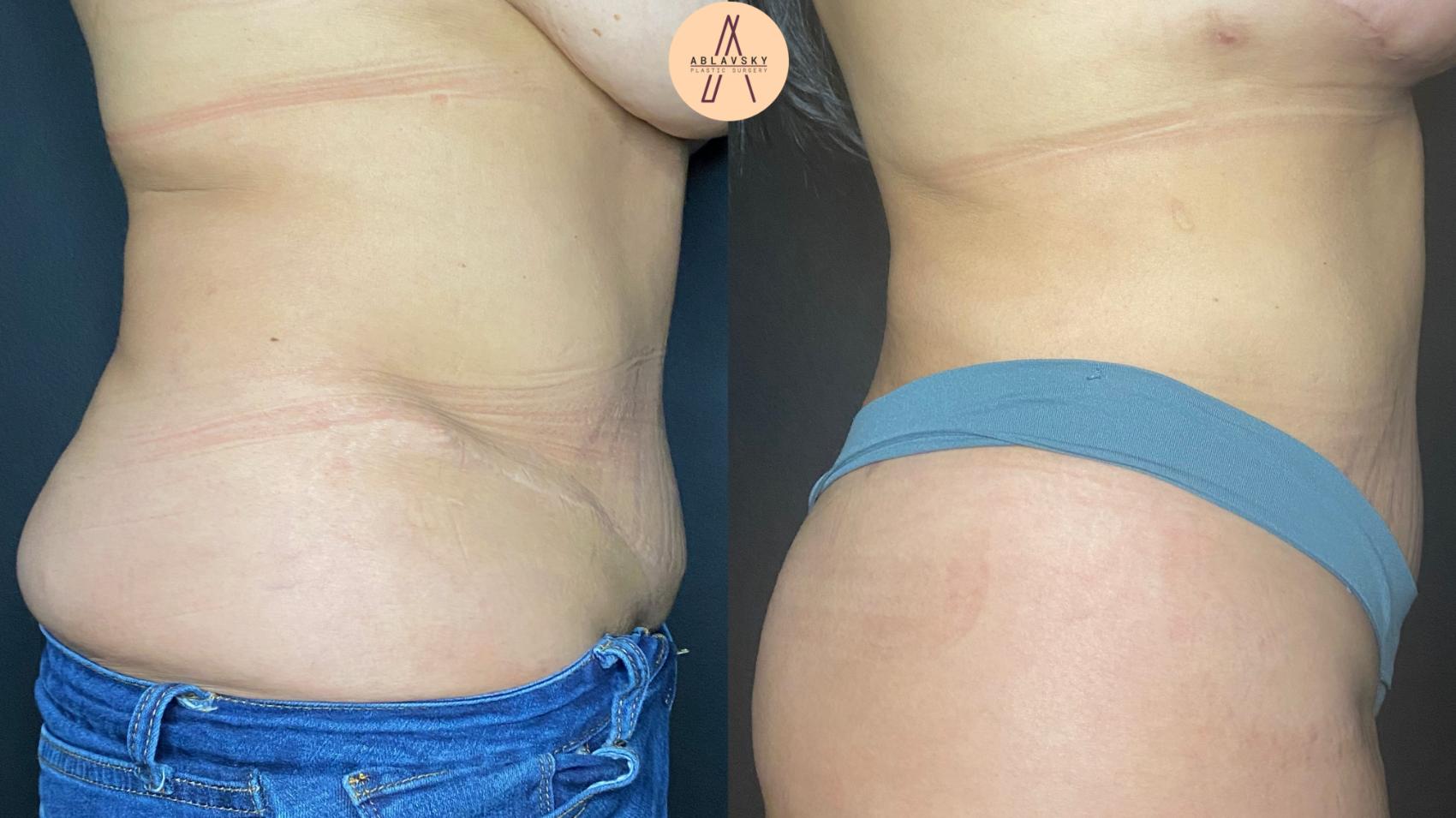 Before & After Liposuction Case 46 Right Side View in San Antonio, Texas