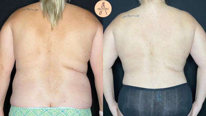 Before & After Liposuction Case 61 Back View in San Antonio, Texas