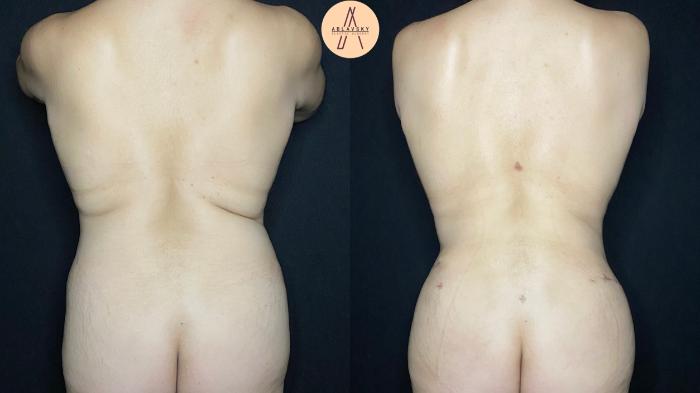 Before & After Liposuction Case 80 Back View in San Antonio, Texas