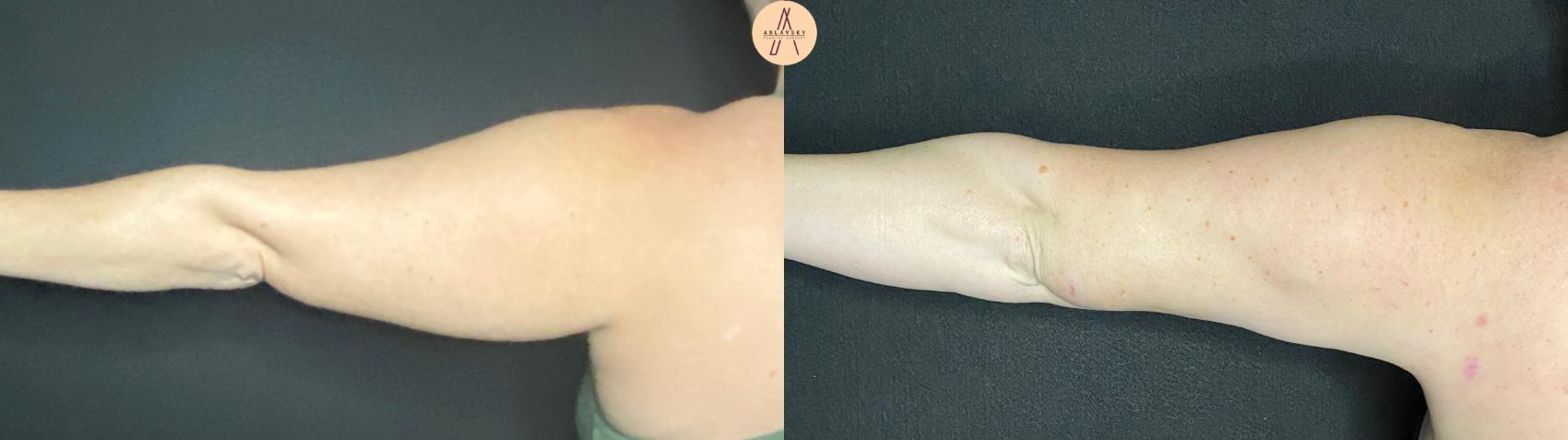Before & After Arm Liposuction Case 82 Left side back View in San Antonio, Texas
