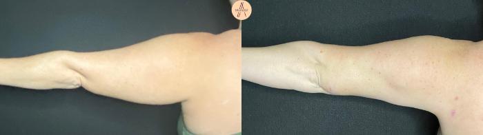 Before & After Liposuction Case 82 Left side back View in San Antonio, Texas