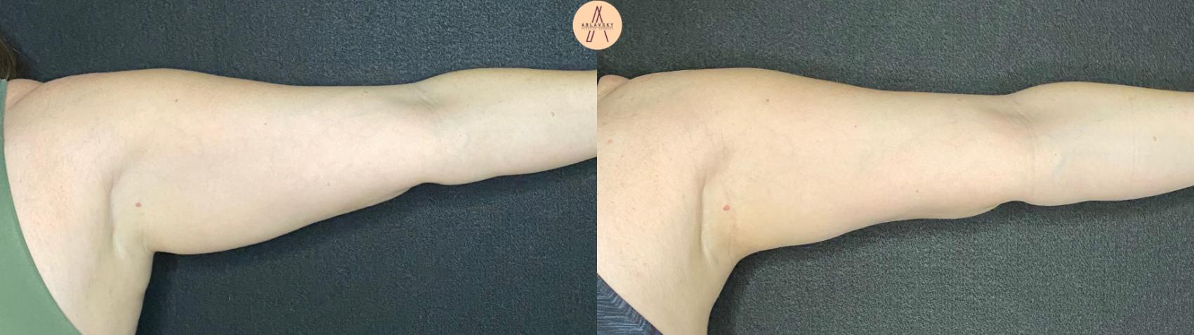 Before & After Arm Liposuction Case 82 Left Side View in San Antonio, Texas
