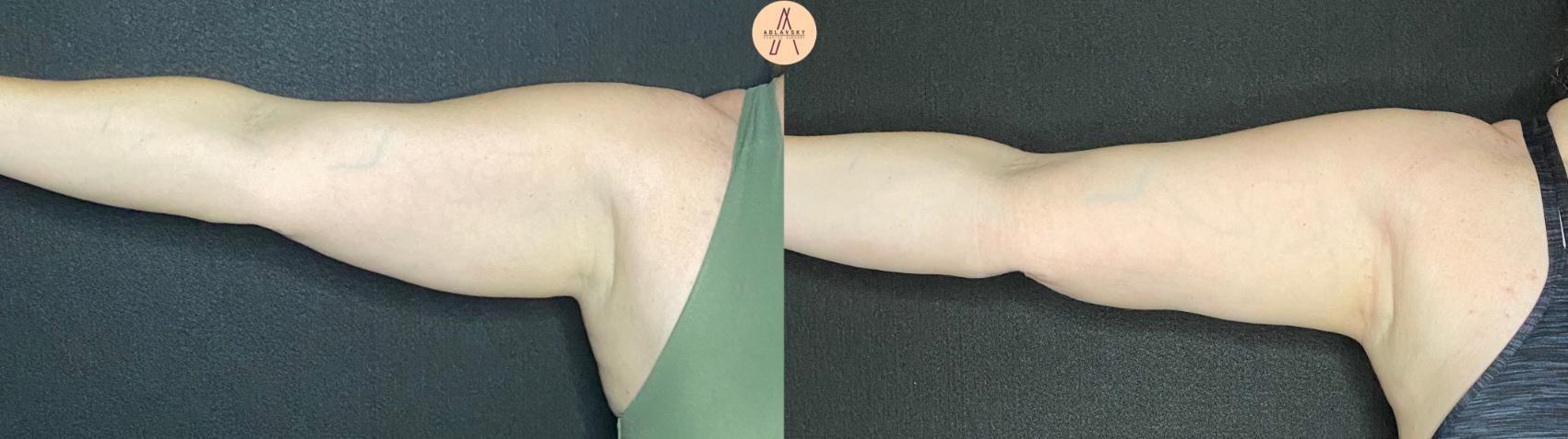 Before & After Arm Liposuction Case 82 Right Side View in San Antonio, Texas