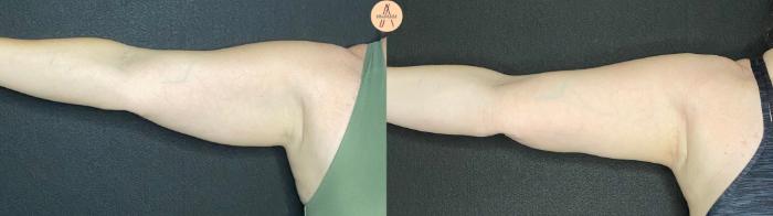 Before & After Liposuction Case 82 Right Side View in San Antonio, Texas