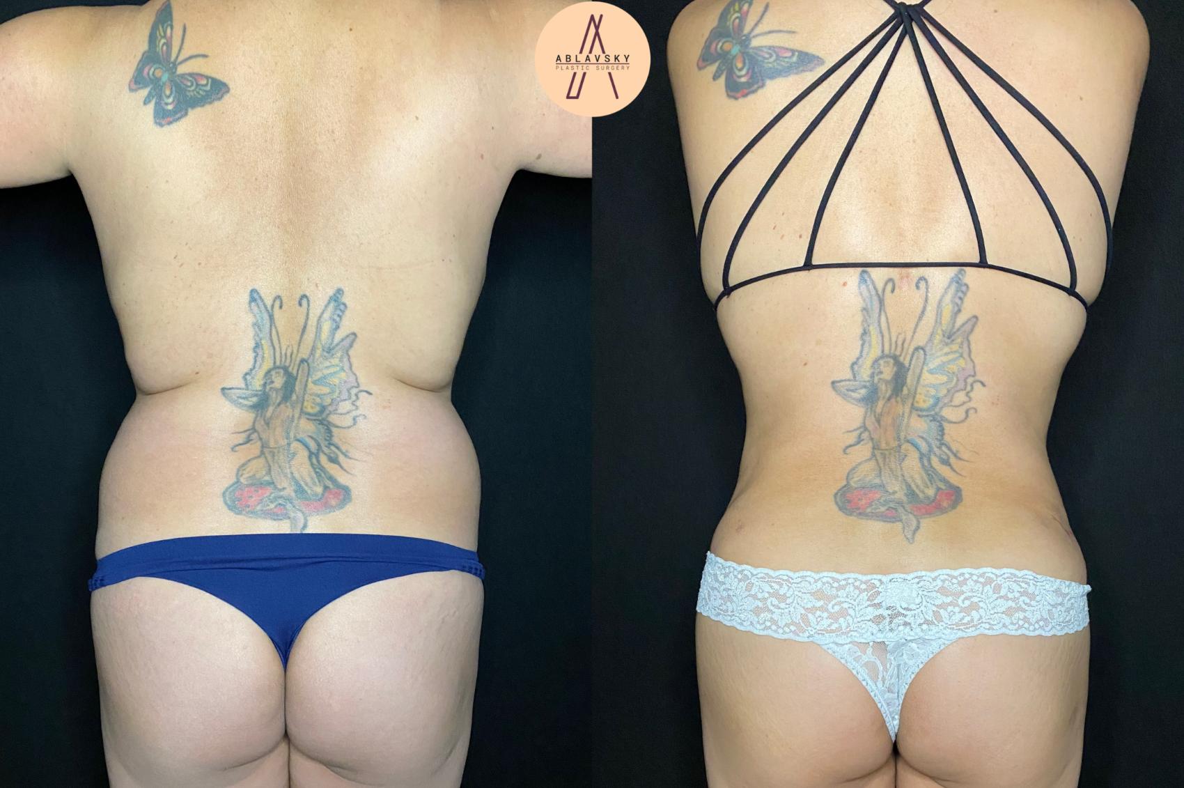 Before & After Liposuction Case 88 Back View in San Antonio, Texas