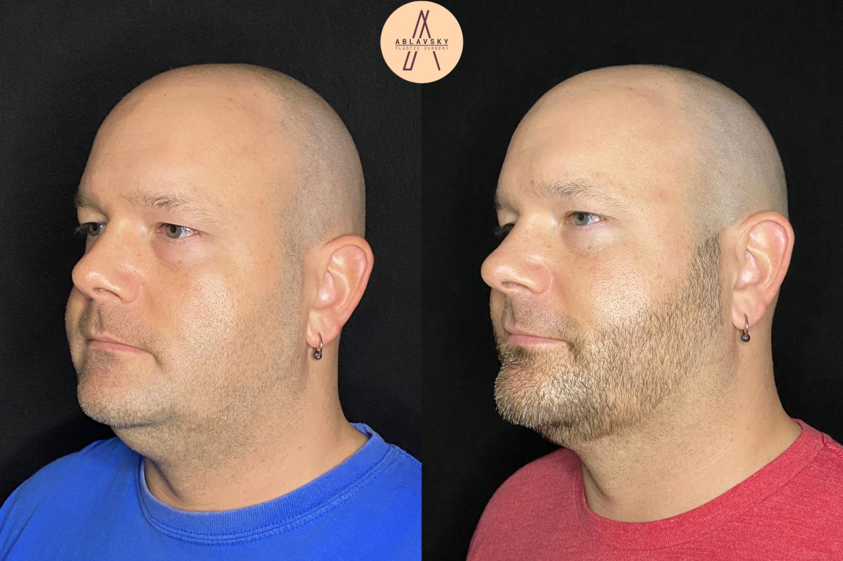 Before & After Submental Liposuction Case 89 Left Oblique View in San Antonio, Texas