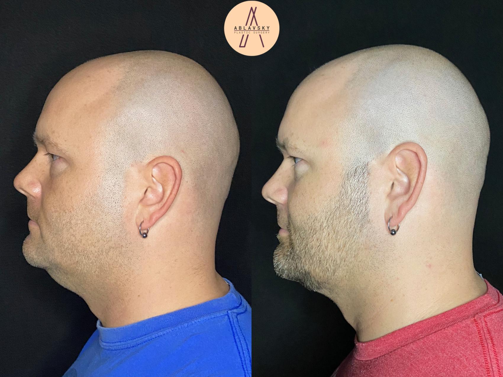 Before & After Submental Liposuction Case 89 Left Side View in San Antonio, Texas