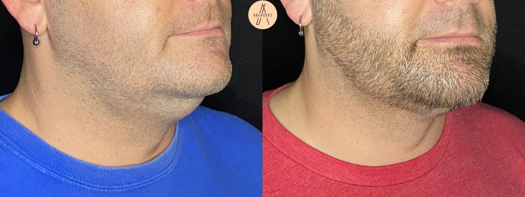Before & After Submental Liposuction Case 89 Right Oblique View in San Antonio, Texas