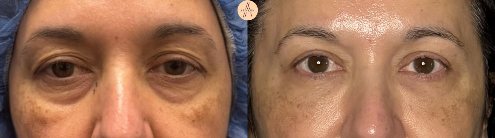 Before & After Lower Blepharoplasty Case 320 Front View in San Antonio, Texas