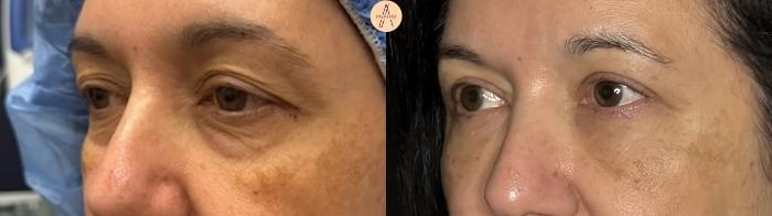 Before & After Lower Blepharoplasty Case 320 Left Oblique View in San Antonio, Texas