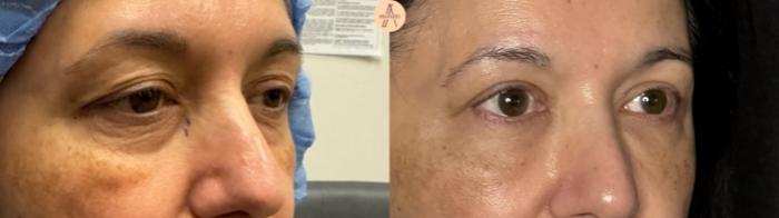 Before & After Lower Blepharoplasty Case 320 Right Oblique View in San Antonio, Texas