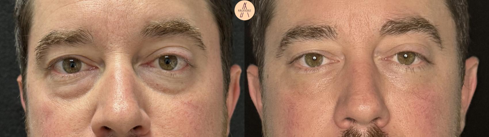 Before & After Lower Blepharoplasty Case 390 Front View in San Antonio, Texas