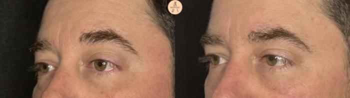 Before & After Lower Blepharoplasty Case 390 Left Oblique View in San Antonio, Texas