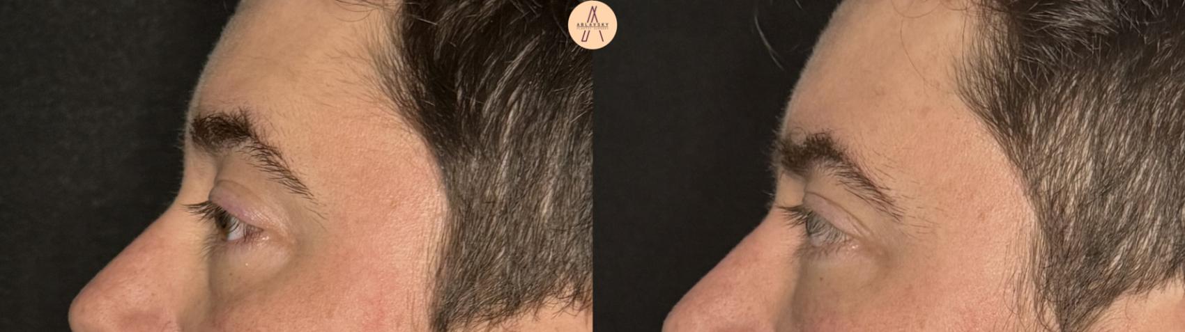 Before & After Lower Blepharoplasty Case 390 Left Side View in San Antonio, Texas