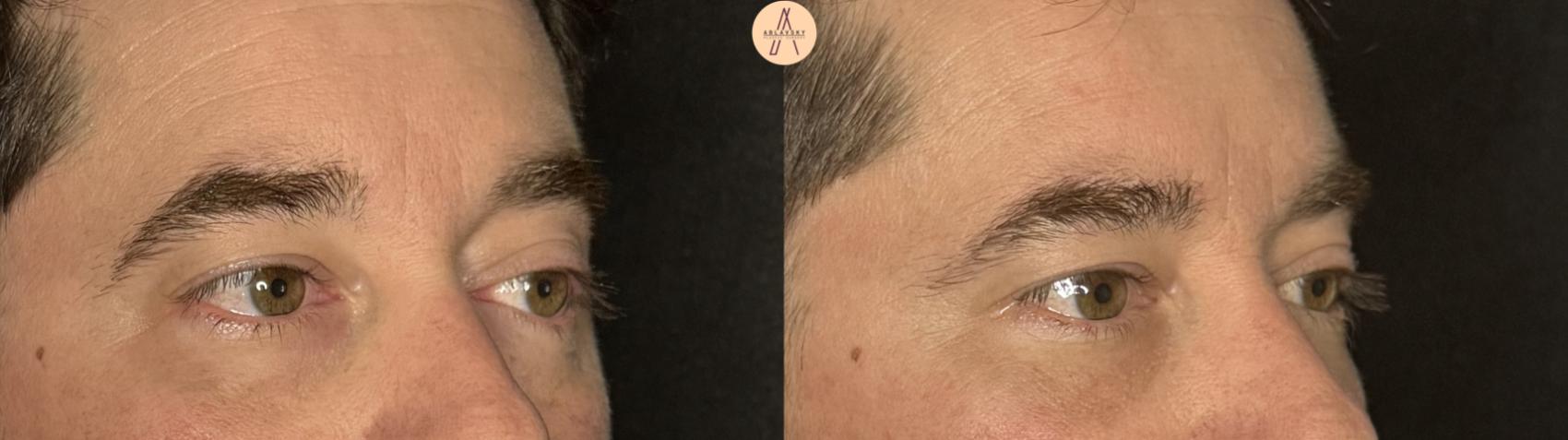 Before & After Lower Blepharoplasty Case 390 Right Oblique View in San Antonio, Texas