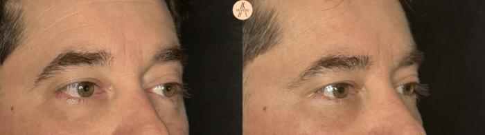 Before & After Lower Blepharoplasty Case 390 Right Oblique View in San Antonio, Texas