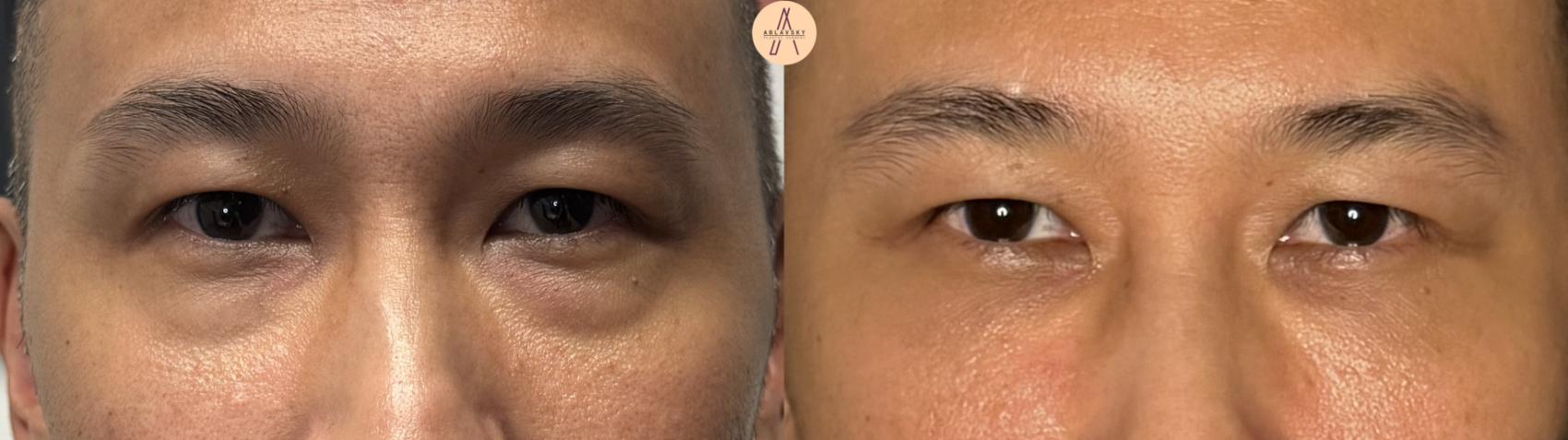 Before & After Lower Blepharoplasty Case 391 Front View in San Antonio, Texas