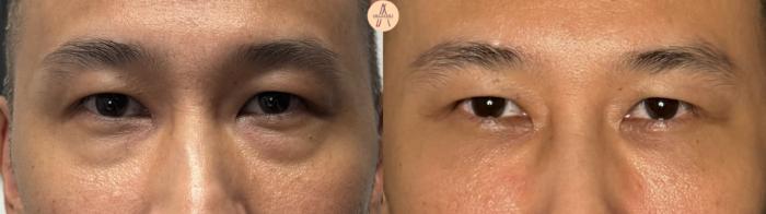 Before & After Lower Blepharoplasty Case 391 Front View in San Antonio, Texas