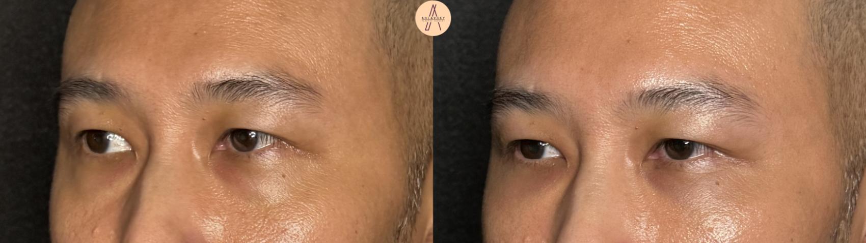 Before & After Facial Fat Grafting Case 391 Left Oblique View in San Antonio, Texas