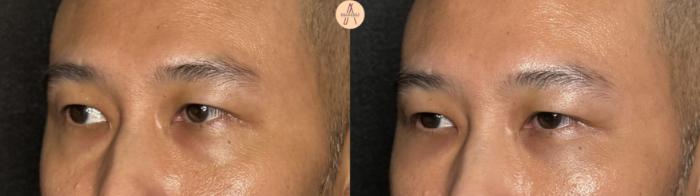 Before & After Lower Blepharoplasty Case 391 Left Oblique View in San Antonio, Texas