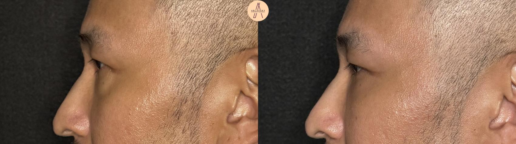Before & After Facial Fat Grafting Case 391 Left Side View in San Antonio, Texas