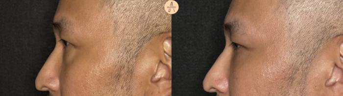 Before & After Lower Blepharoplasty Case 391 Left Side View in San Antonio, Texas