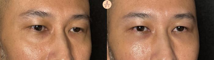 Before & After Lower Blepharoplasty Case 391 Right Oblique View in San Antonio, Texas