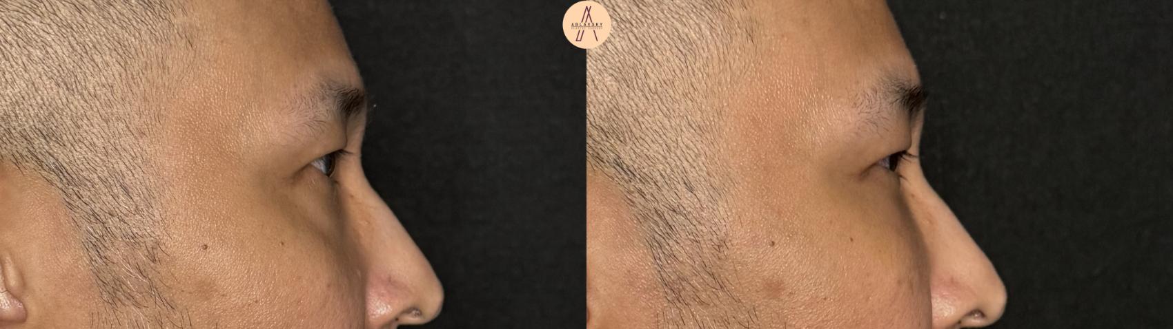 Before & After Facial Fat Grafting Case 391 Right Side View in San Antonio, Texas