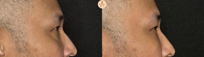 Before & After Lower Blepharoplasty Case 391 Right Side View in San Antonio, Texas