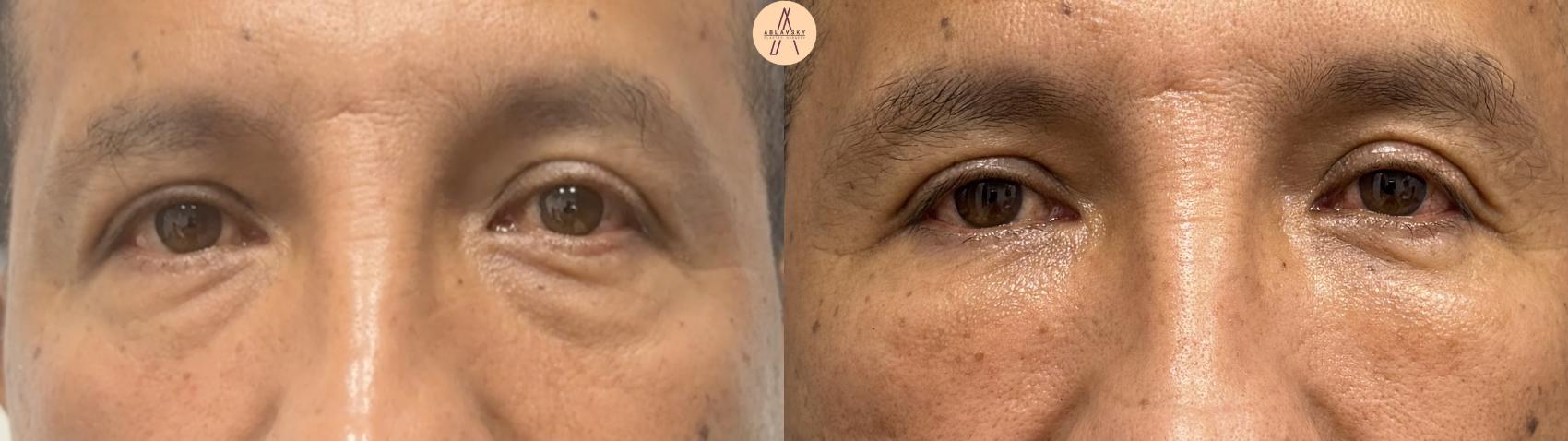 Before & After Lower Blepharoplasty Case 394 Front View in San Antonio, Texas