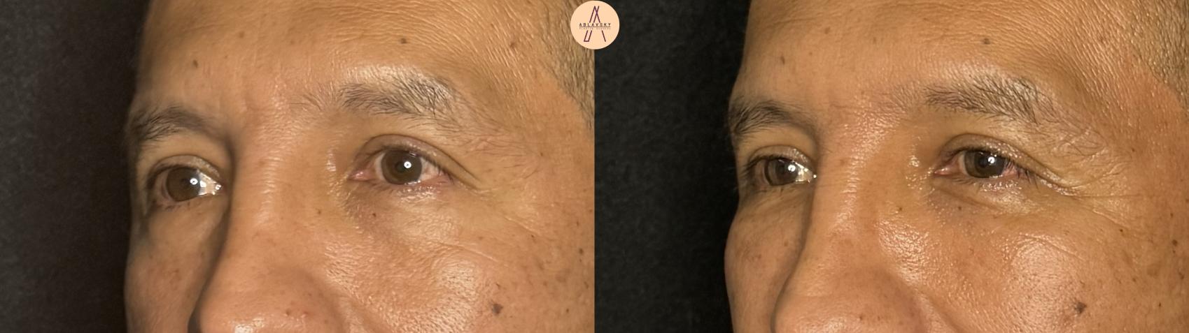Before & After Facial Fat Grafting Case 394 Left Oblique View in San Antonio, Texas