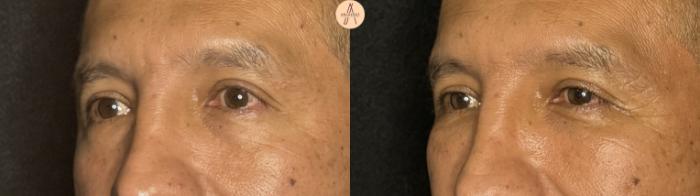 Before & After Lower Blepharoplasty Case 394 Left Oblique View in San Antonio, Texas