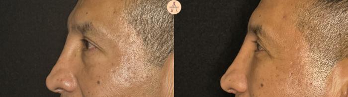 Before & After Lower Blepharoplasty Case 394 Left Side View in San Antonio, Texas