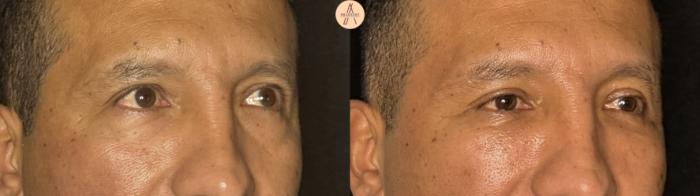 Before & After Lower Blepharoplasty Case 394 Right Oblique View in San Antonio, Texas