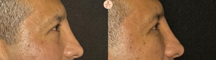 Before & After Lower Blepharoplasty Case 394 Right Side View in San Antonio, Texas