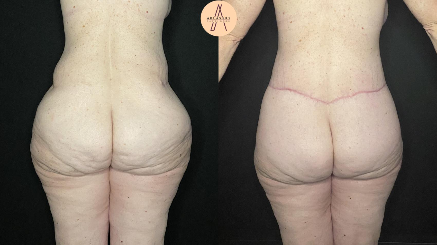 Before & After Lower / circumferential body lift Case 186 Back View in San Antonio, Texas