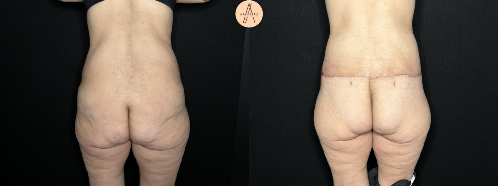 Before & After Tummy Tuck Case 258 Back View in San Antonio, Texas