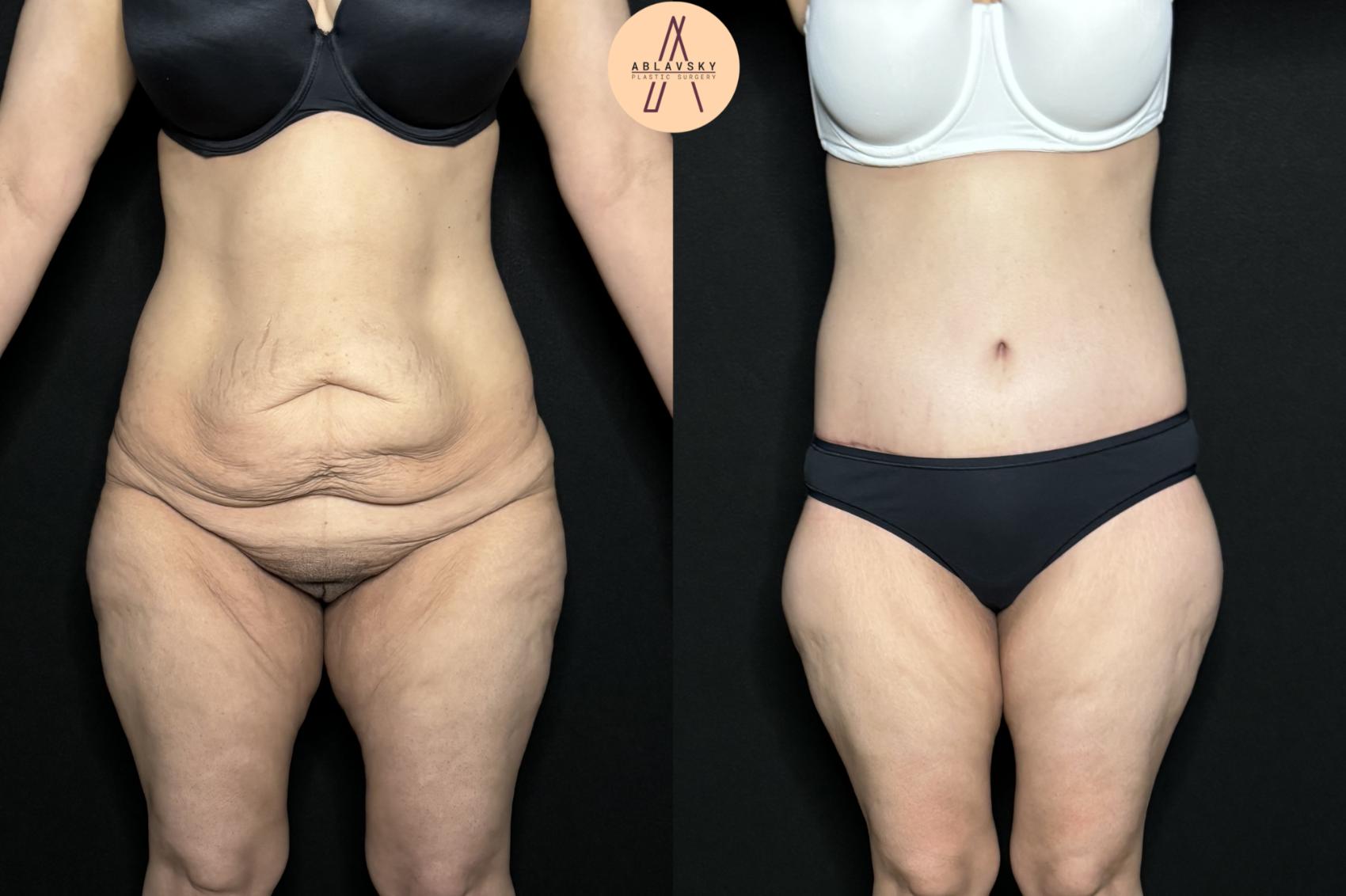 Before & After Lower / circumferential body lift Case 258 Front View in San Antonio, Texas