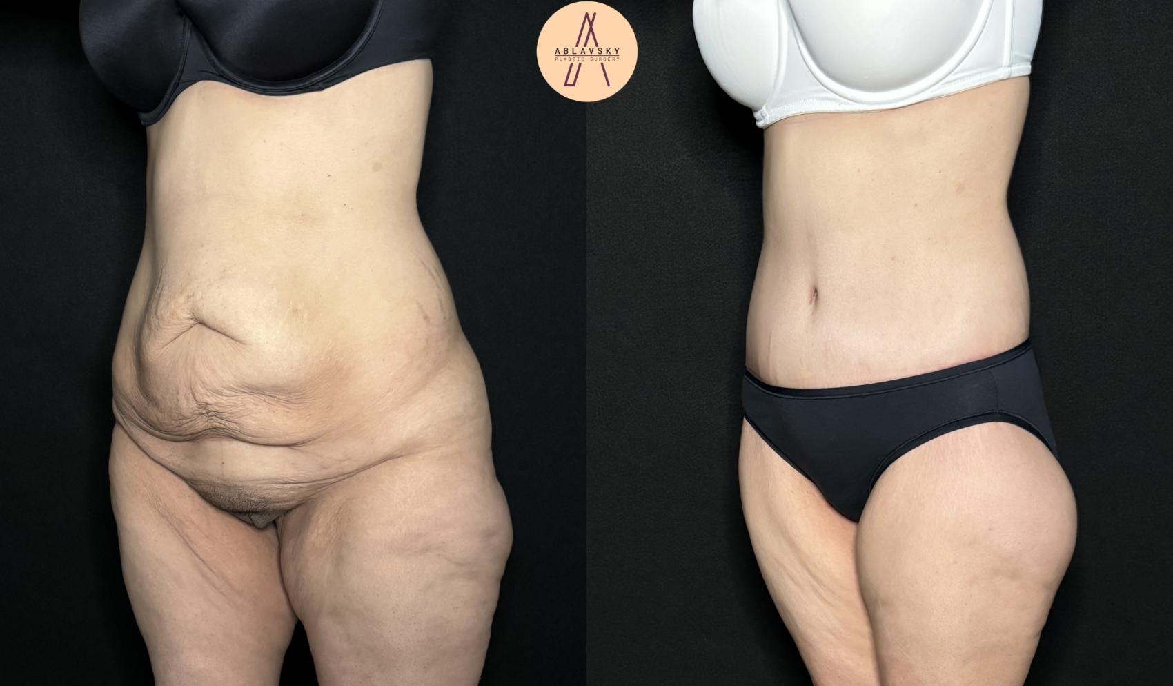 Before & After Tummy Tuck Case 258 Left Oblique View in San Antonio, Texas
