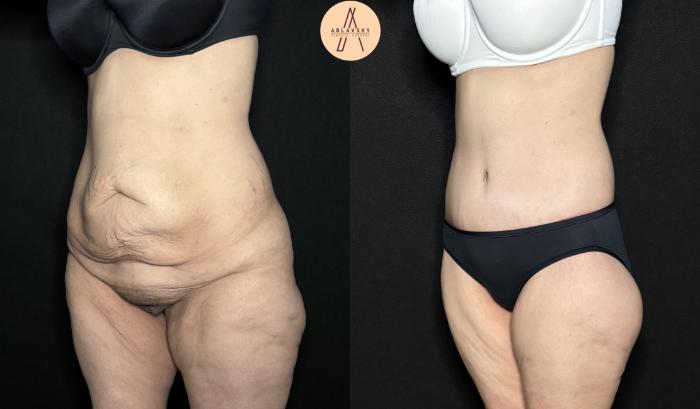 Before & After Lower / circumferential body lift Case 258 Left Oblique View in San Antonio, Texas