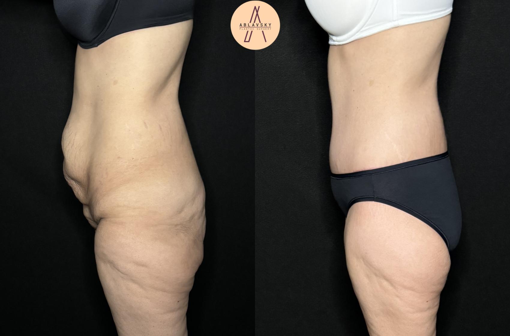 Before & After Tummy Tuck Case 258 Left Side View in San Antonio, Texas