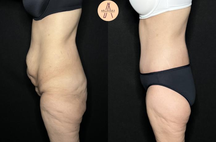 Before & After Lower / circumferential body lift Case 258 Left Side View in San Antonio, Texas