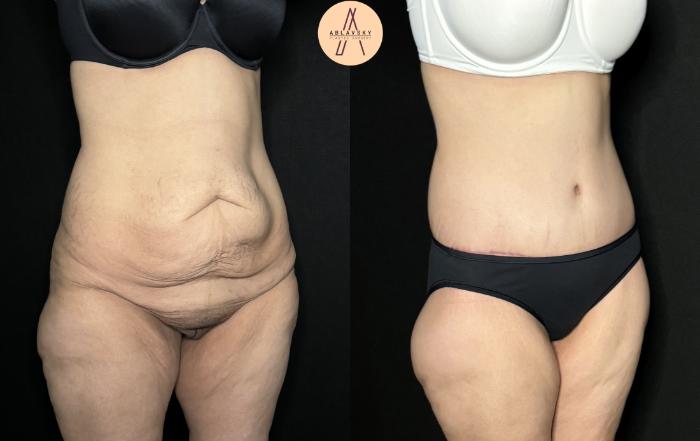 Before & After Lower / circumferential body lift Case 258 Right Oblique View in San Antonio, Texas