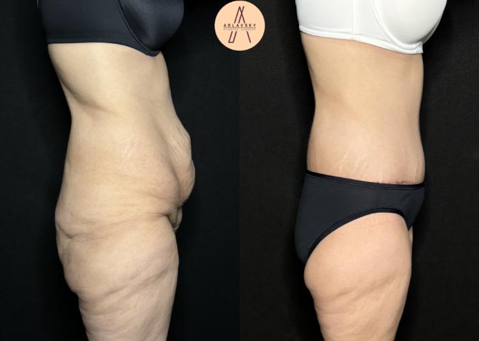 Before & After Lower / circumferential body lift Case 258 Right Side View in San Antonio, Texas