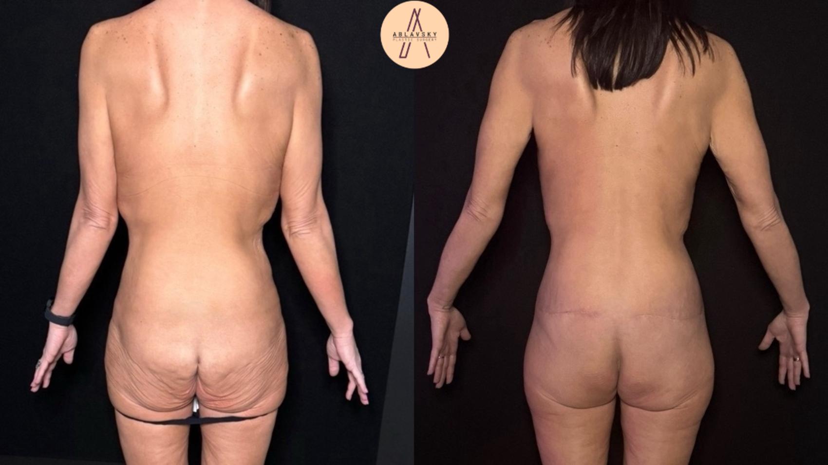 Before & After Lower / circumferential body lift Case 483 Back View in San Antonio, Texas