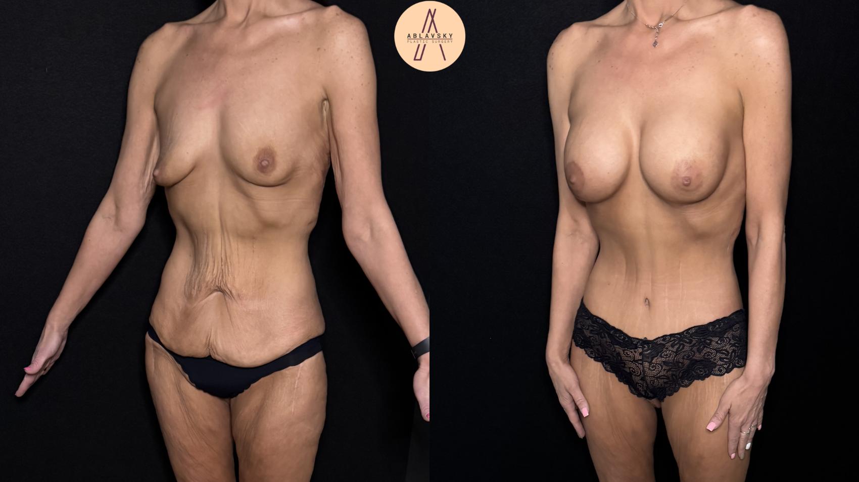 Before & After Lower / circumferential body lift Case 483 Left Oblique View in San Antonio, Texas