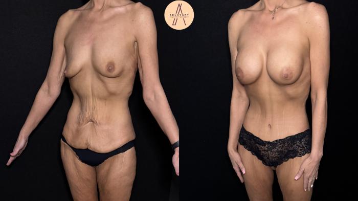 Before & After Lower / circumferential body lift Case 483 Left Oblique View in San Antonio, Texas